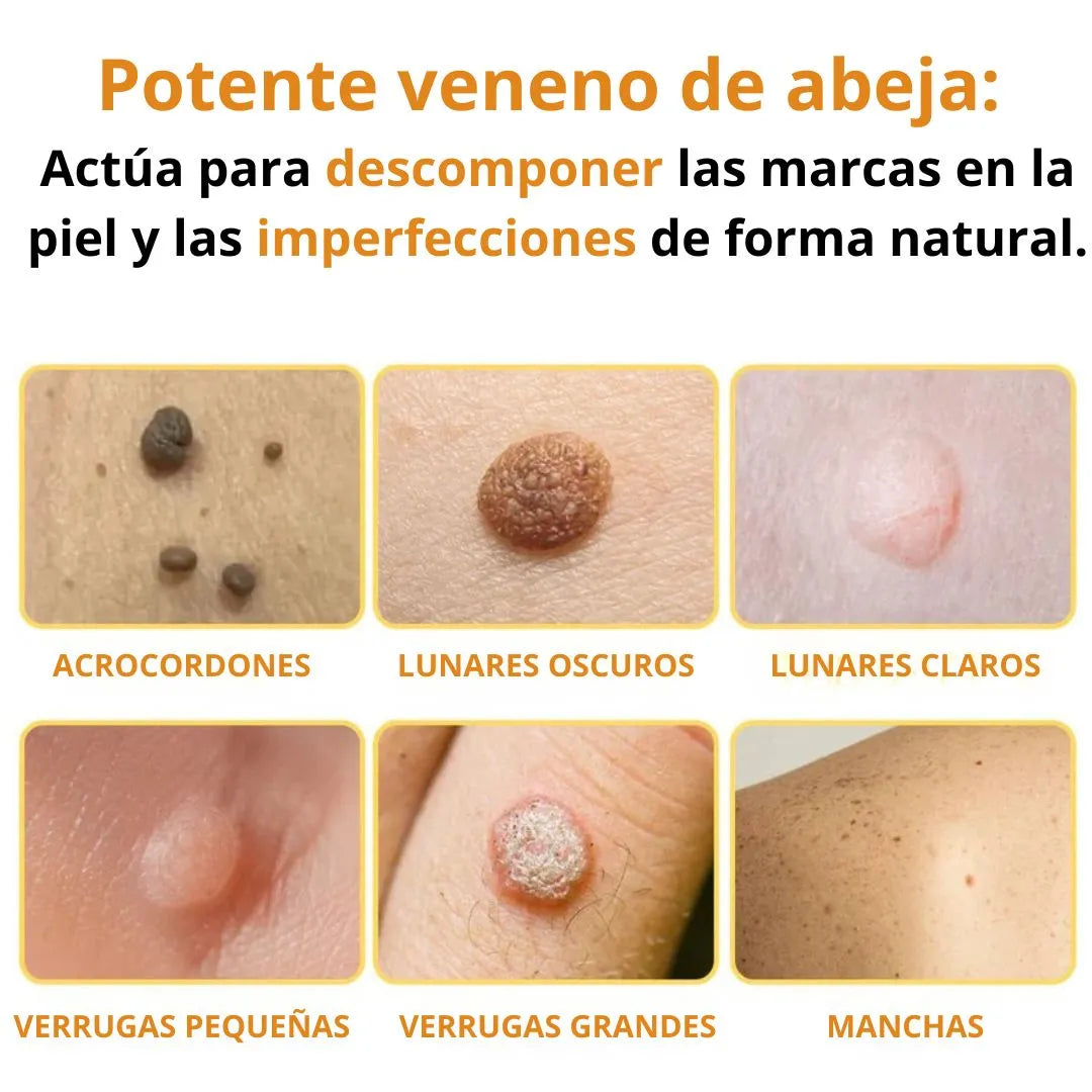 SkinClear Pro: Eliminador de Verrugas